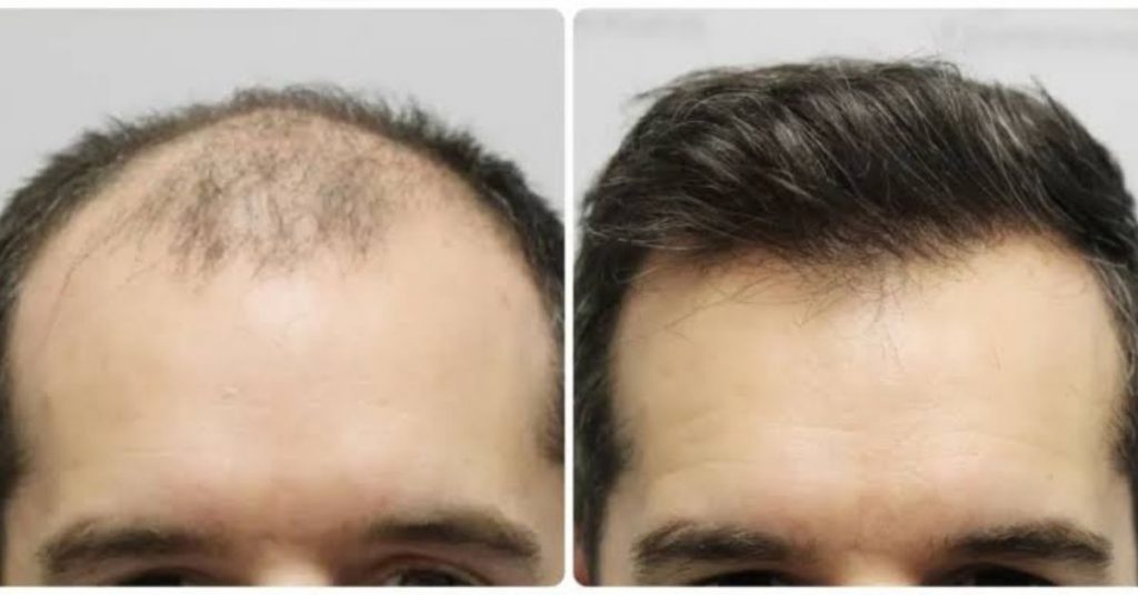 Men’s Hair Restoration Guide